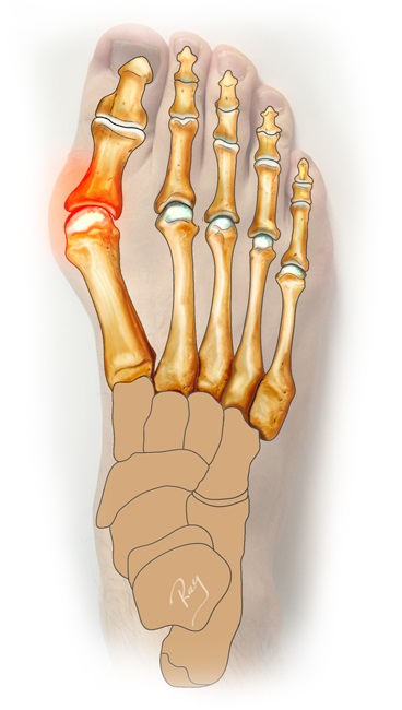 an drawing explaining Halux Valgus