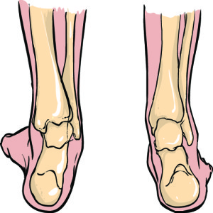 Overpronation a drawing showing overpronation