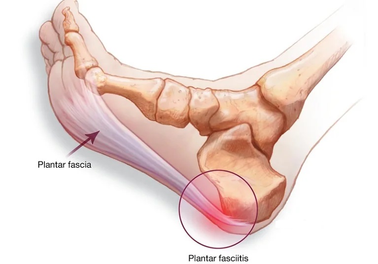 Plantar fasciopathy a drawing explaining Plantar fasciopathy